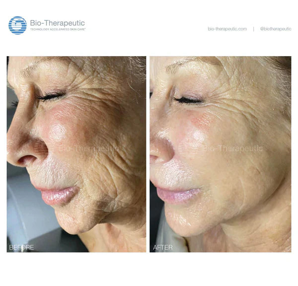 BT Sculpt GEN2 | Microcurrent | Facial Sculpting Device