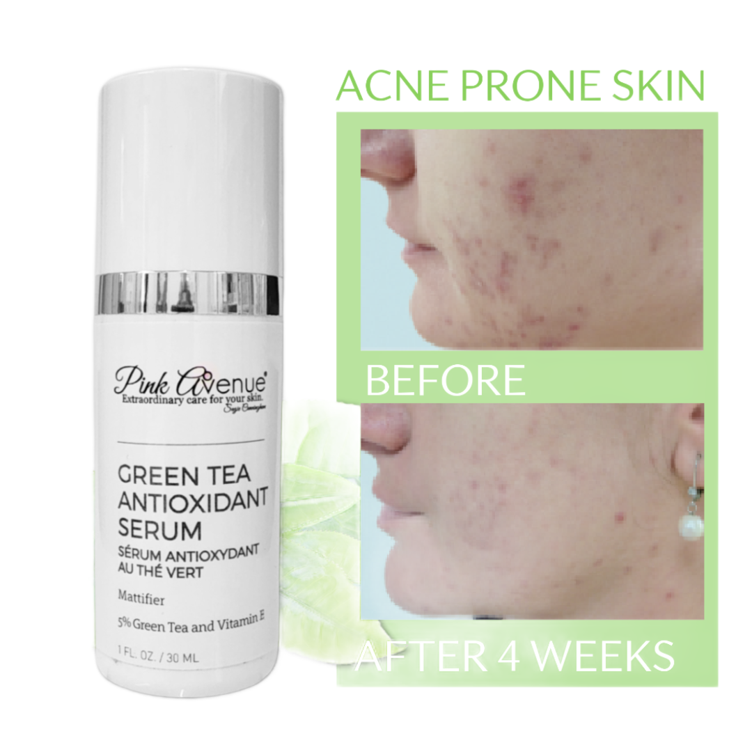 Pink Avenue Green Tea Antioxidant Serum before and after comparison - showing skin tone evening and redness reduction benefits of dermatologist formulated green tea serum, shipped from Toronto, Canada