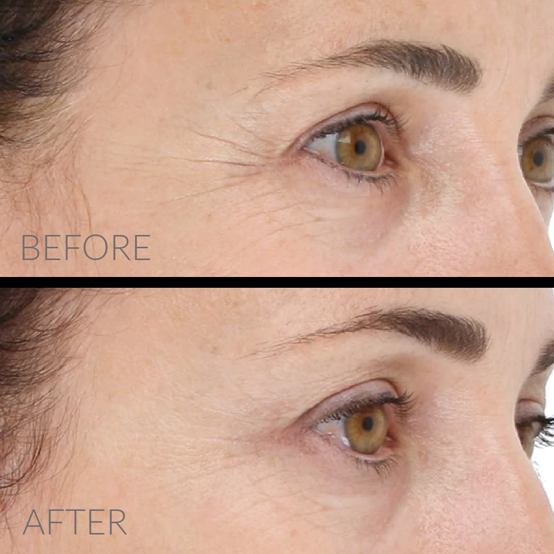 LightStim For Wrinkles, Free Shipping, Pink Avenue, Toronto, Canada