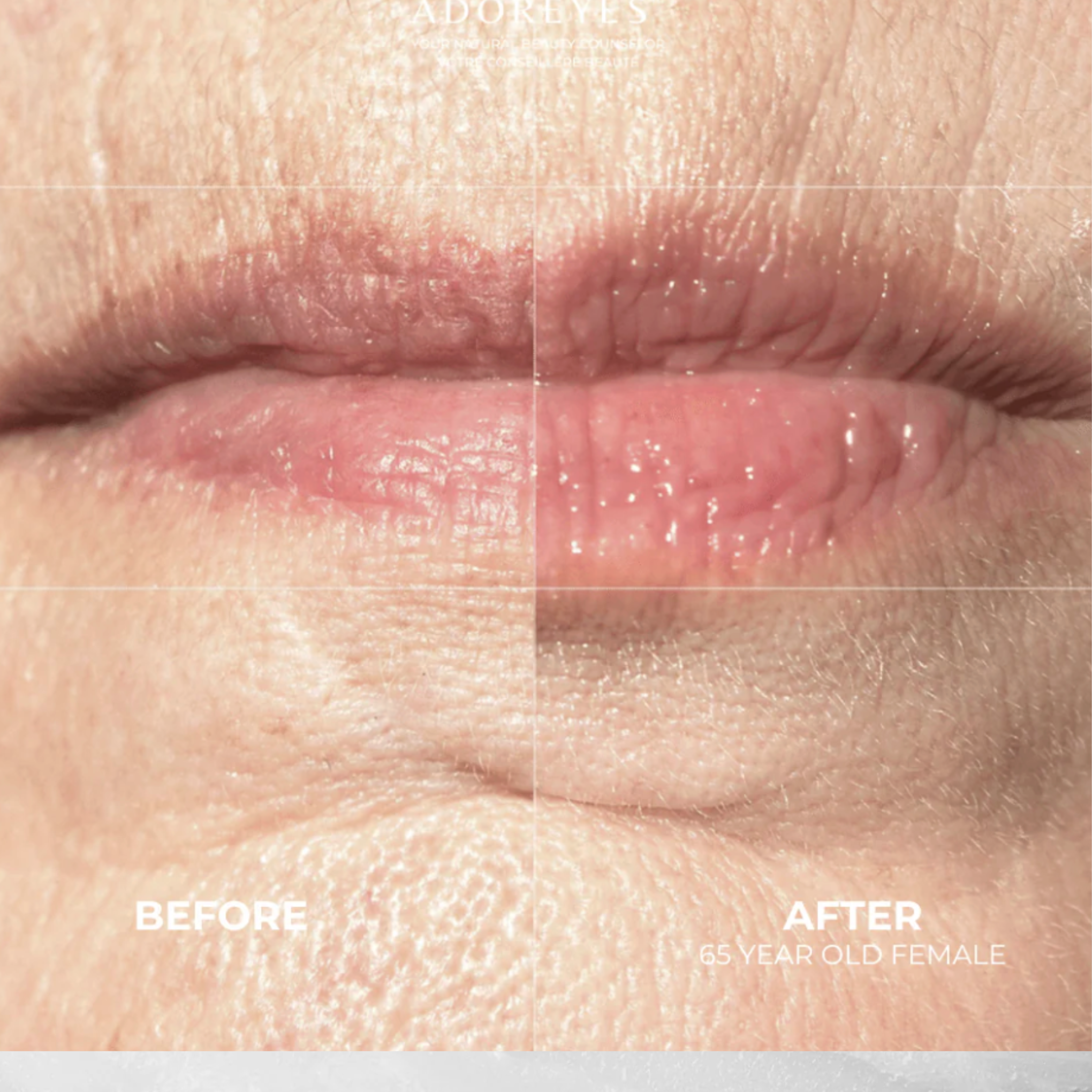 Adoreyes PepChat Antaŭ kaj post komparo de lipoj en proksima vido, montrante la lipojn de 65-jaraĝa virino.