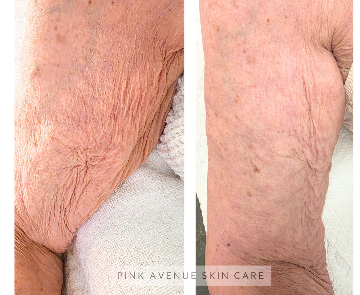 SQT Clarify Arm Before and After — After 1 Session, Pink Avenue Skin Care Toronto