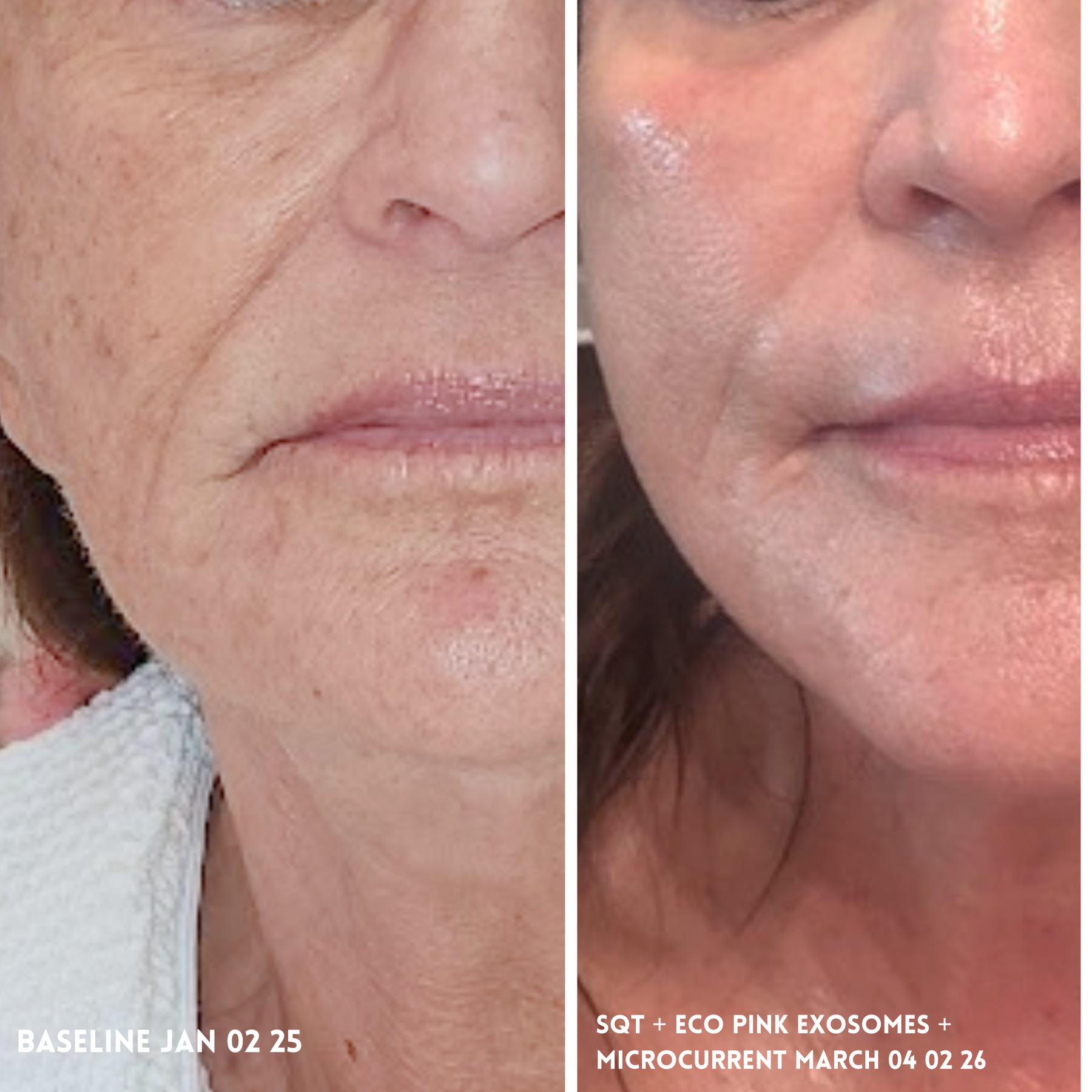 Before and after results with ECO Pink Evolve Exosomes Bio Serum