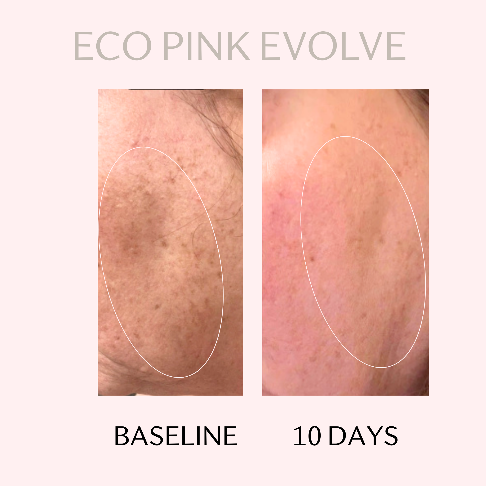Before and after comparison of skin treatment with 'Eco Pink Evolve' showing baseline and 10-day results.