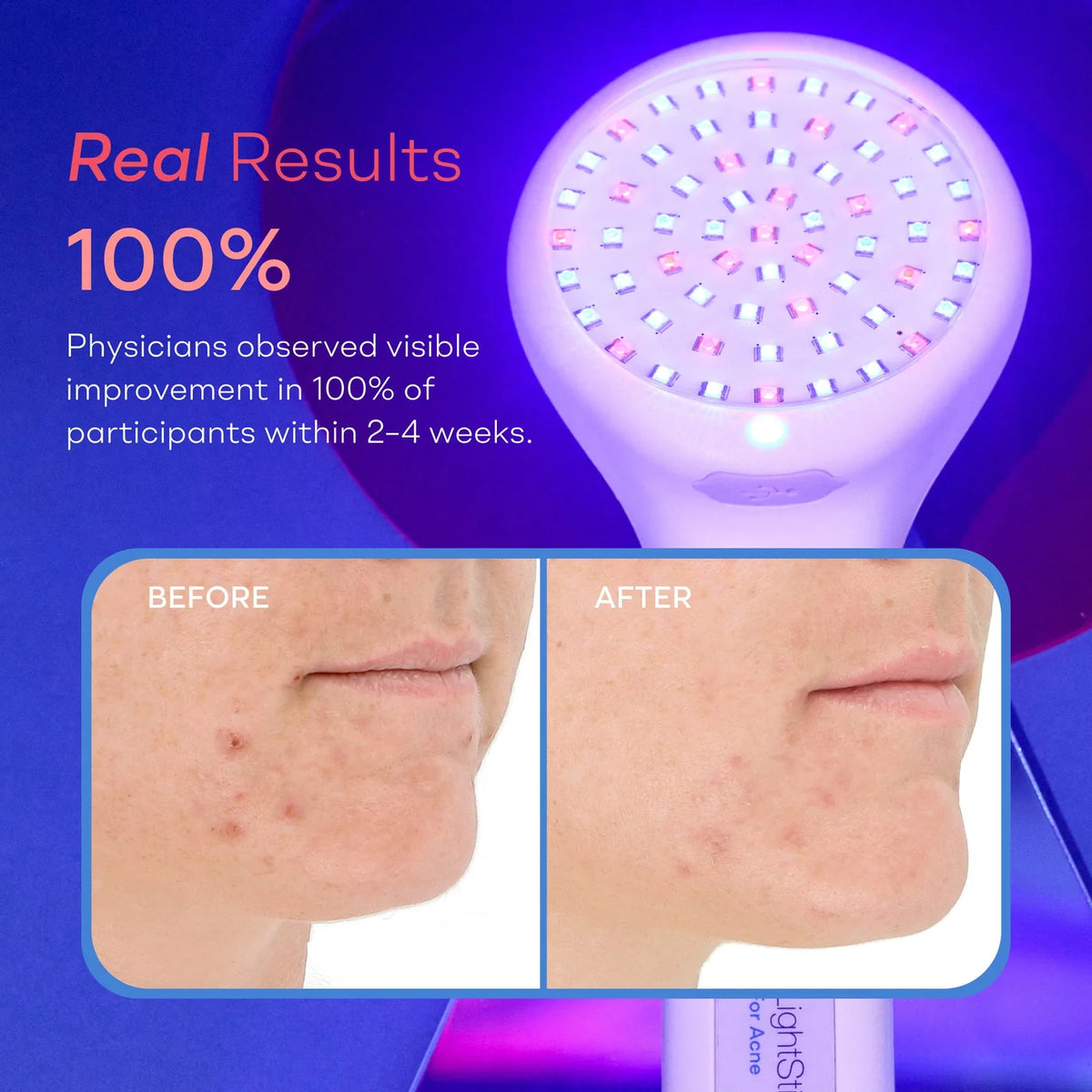LightStim for Acne before and after results showing clearer skin