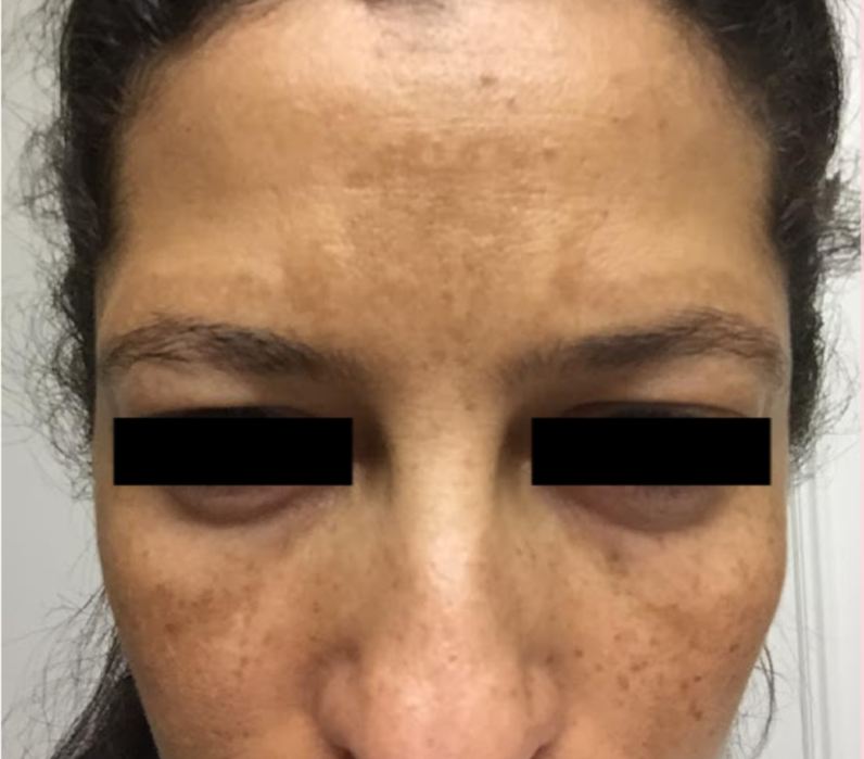 Before — over-treated, reactive skin