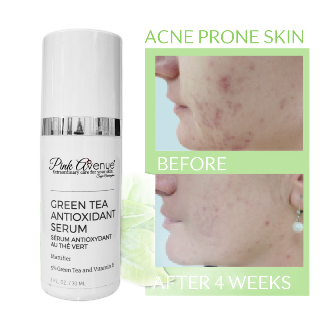 Pink Avenue Green Tea Serum, acne prone skin, Toronto, Canada