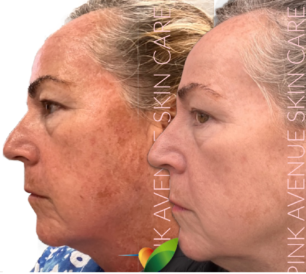 SQT Revitalize Before and After - Pink Avenue Skin Care Toronto