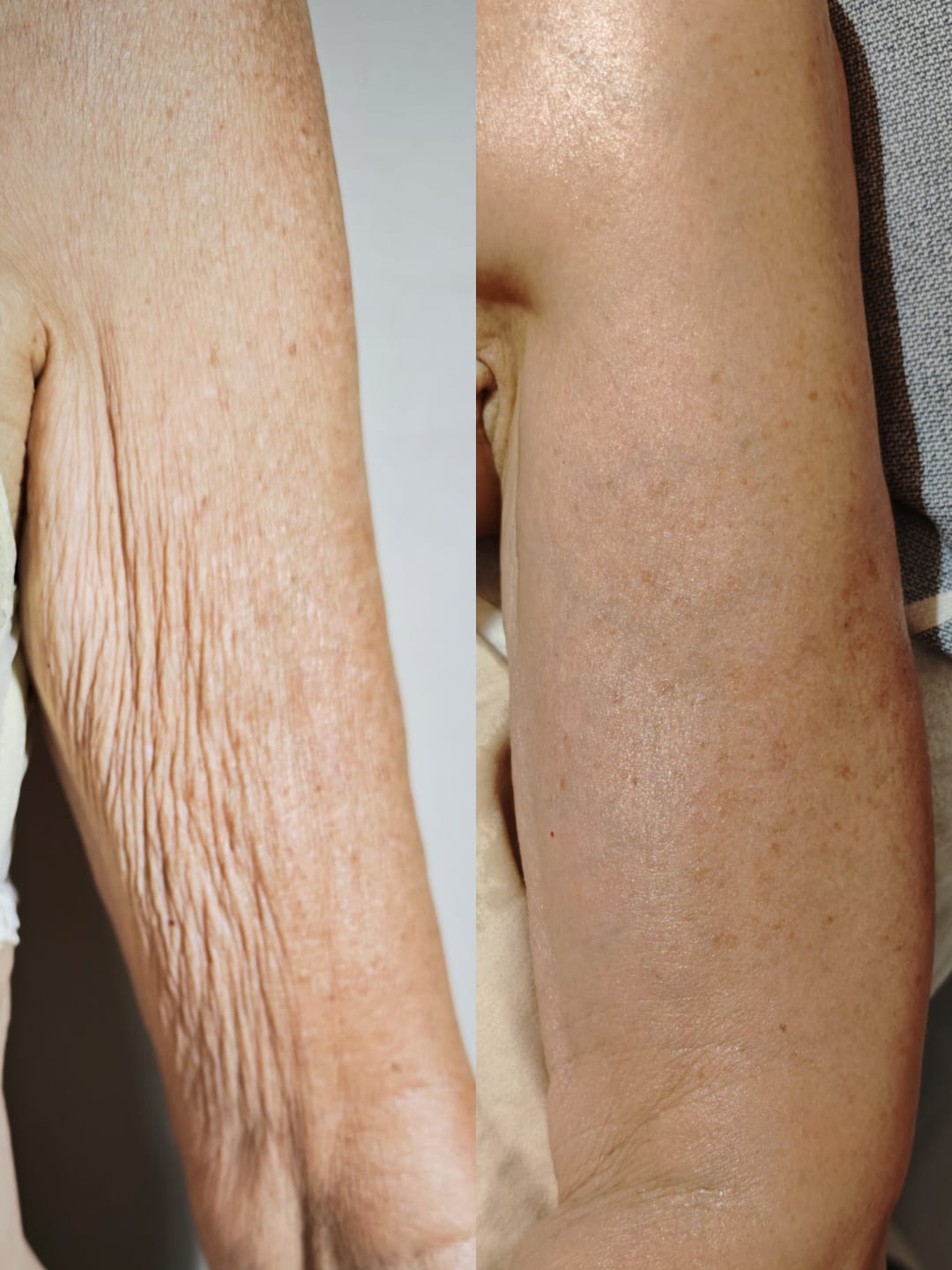 SQT Clarify Body — Results After 4 Sessions, Pink Avenue Skin Care Toronto