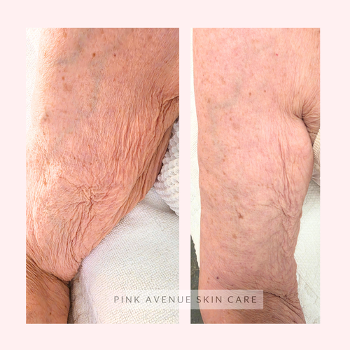 SQT Clarify Body Bio Microneedling