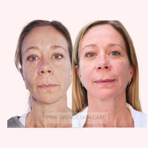 SQT Revitalize Bio Microneedling