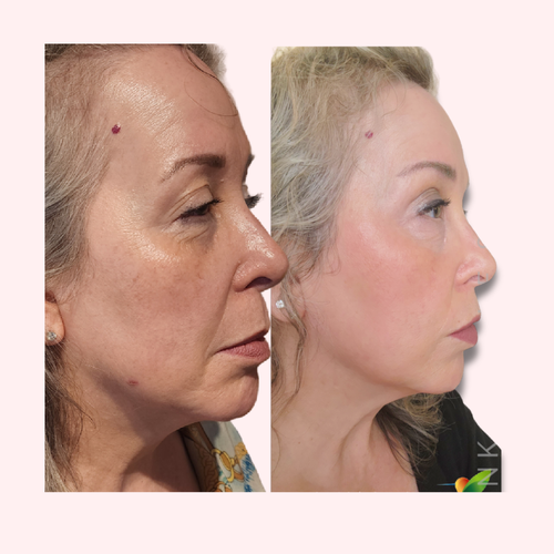 SQT Rejuvenate Bio Microneedling