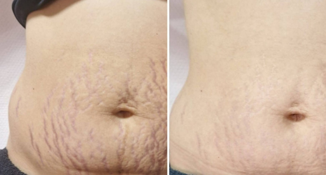SQT Clarify Body Before and After Results, Pink Avenue Skin Care Toronto
