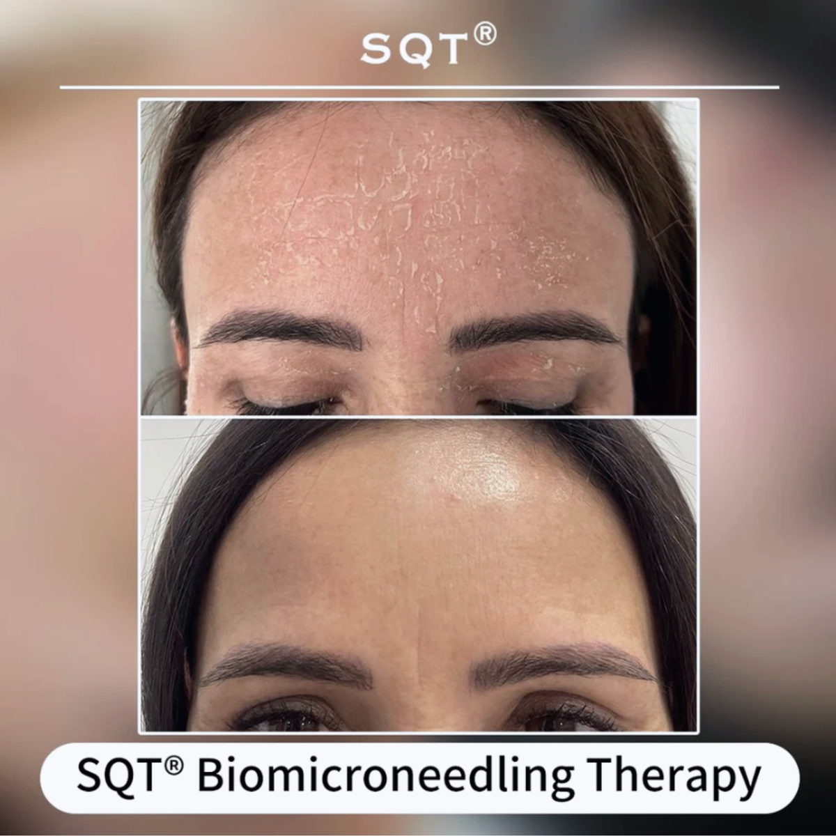 SQT Nourish Before and After Results, Pink Avenue Skin Care Toronto