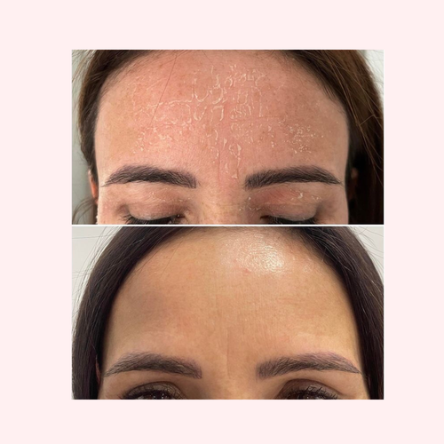 SQT Nourish Bio Microneedling