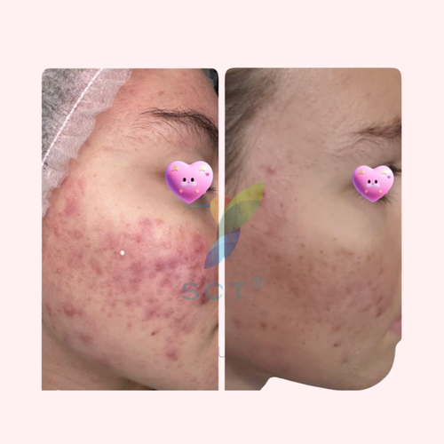 SQT Resurface Bio Microneedling