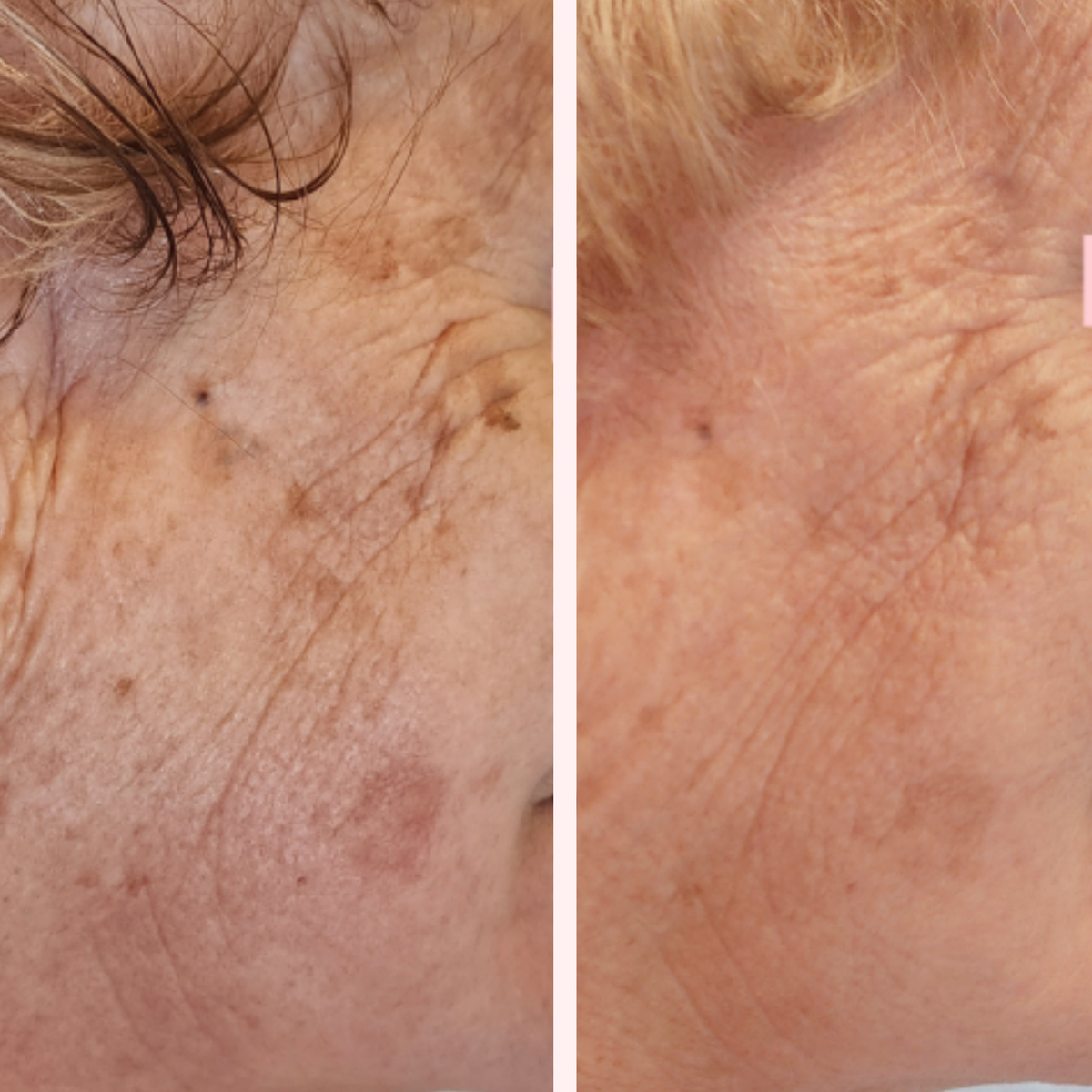 SQT Nourish Before and After Results, Pink Avenue Skin Care Toronto