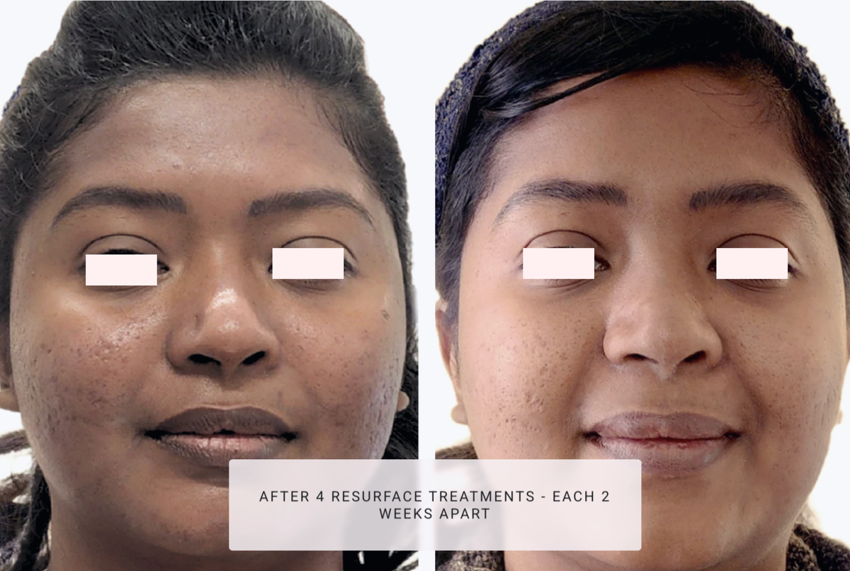 SQT Resurface Before and After - Pink Avenue Skin Care Toronto