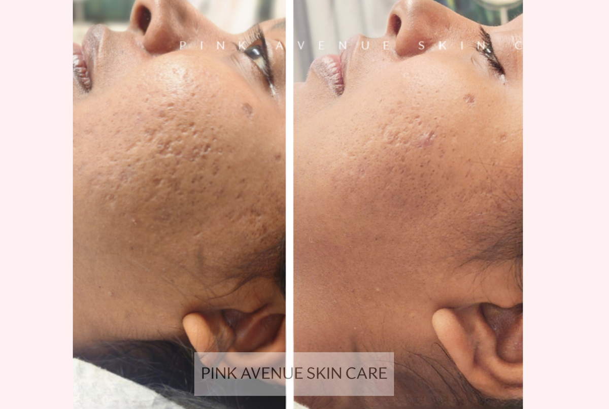 SQT Resurface Before and After - Pink Avenue Skin Care Toronto