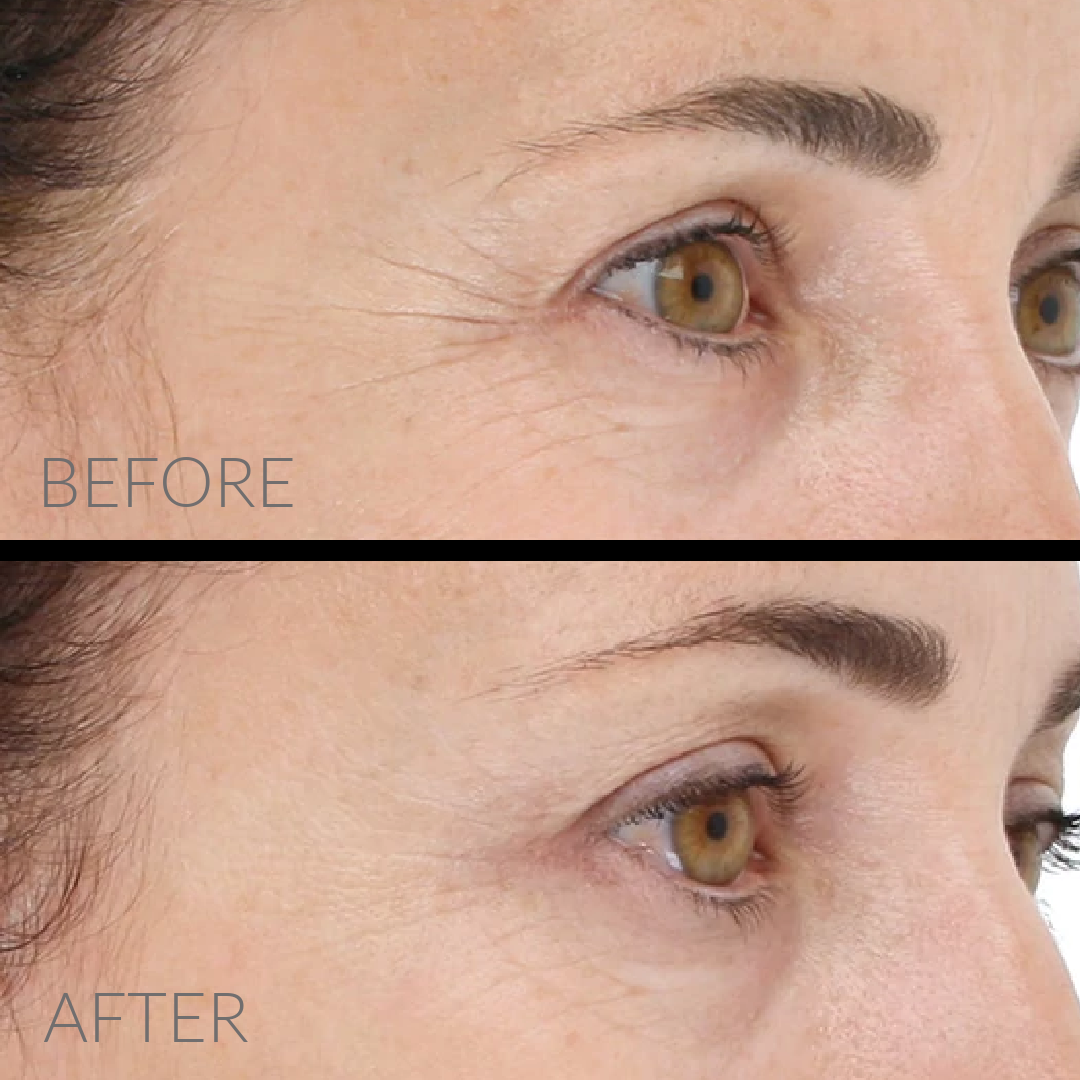 LightStim For Wrinkles، حمل و نقل رایگان، خیابان صورتی، تورنتو، کانادا